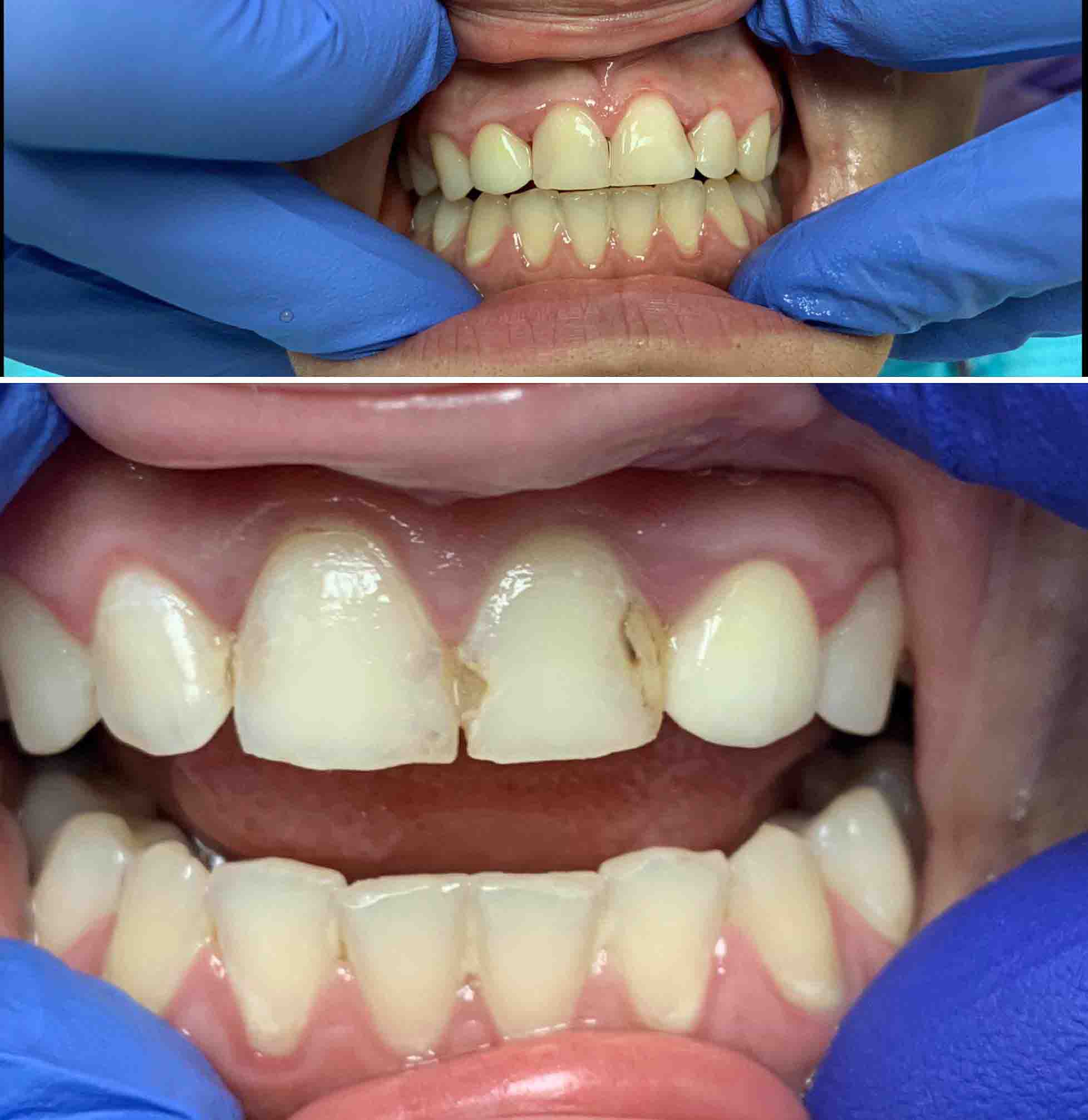 Filling Cavity Front Tooth Filling Cavity Front Tooth