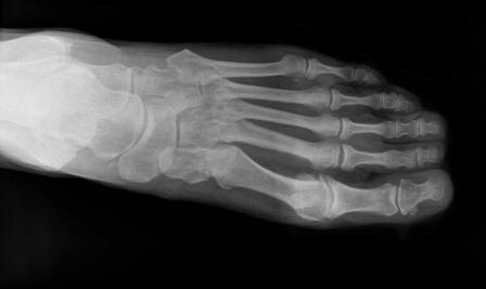 First Metatarsophalangeal Joint Pain: Relieve Symptoms Fast