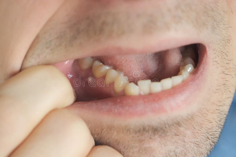 Fistula In Mouth
