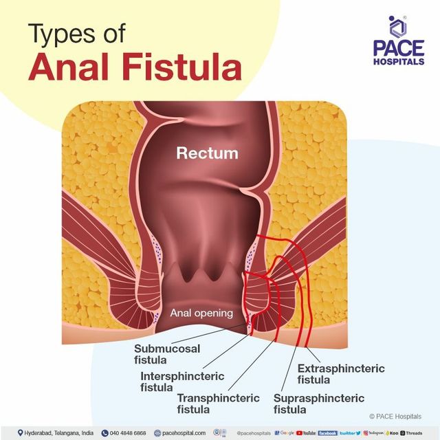 Fistula Symptoms And Cure Guide Fistula Symptoms And Cure Guide