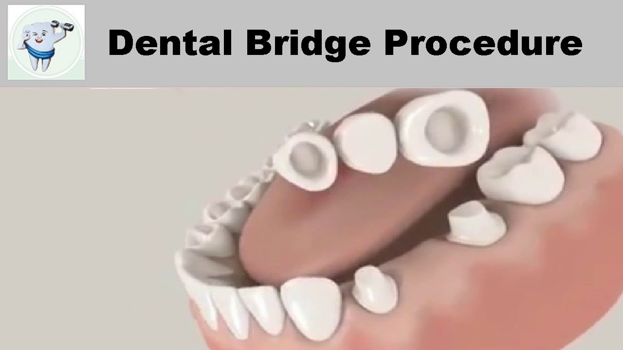 Fixed Teeth Bridge: Cost Breakdown Explained