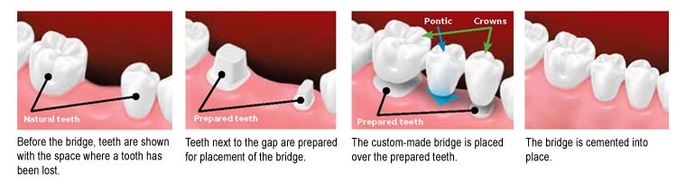 Fixed Vs Removable Bridges St Lawrence Dentistry Fixed Vs Removable Bridges St Lawrence Dentistry