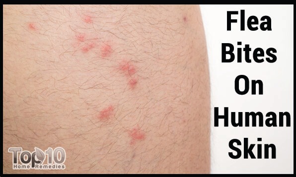 Flea Bite Relief: Stop The Itching And Infection Flea Bite Relief: Stop The Itching And Infection