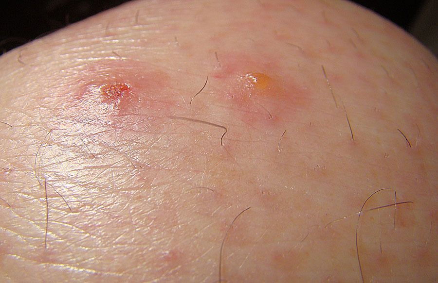 Flea Bite Vs Chigger Bite