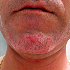 Foliculitis En Barba