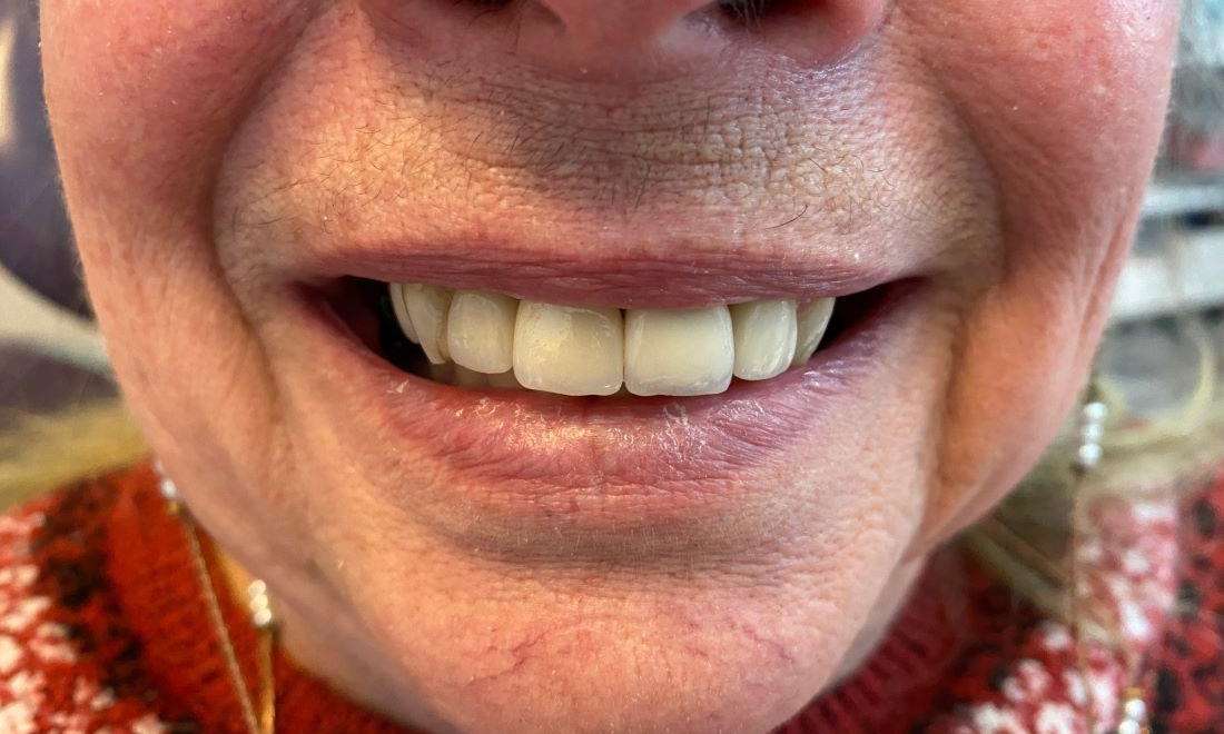 Front Teeth Implants: Comprehensive Guide To Options Front Teeth Implants: Comprehensive Guide To Options