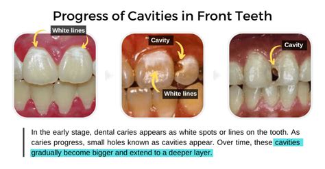 Front Tooth Cavities Front Tooth Cavities