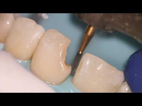 Front Tooth Filling Options Explained