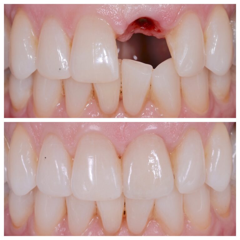 Front Tooth Implants Front Tooth Implants