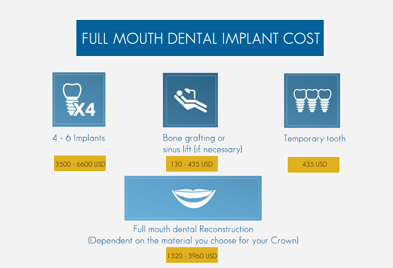 Full Mouth Implant Prices