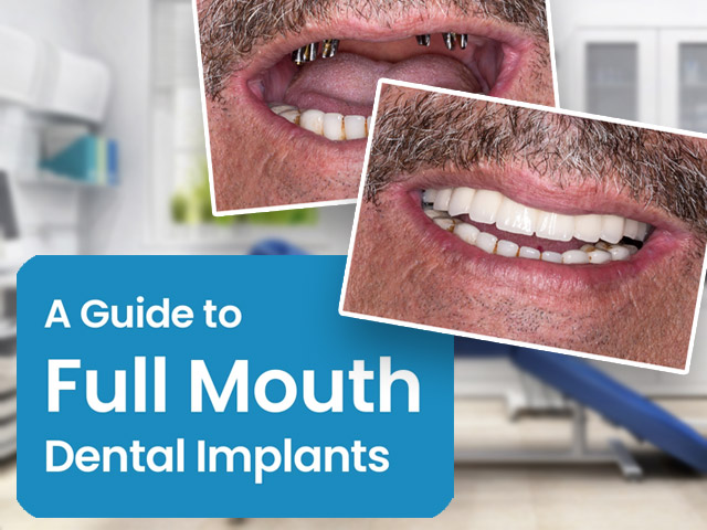 Full Mouth Implants: Your Comprehensive Guide