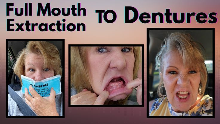 Full Mouth Teeth