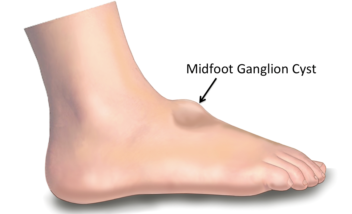 Ganglion Cyst After Surgery