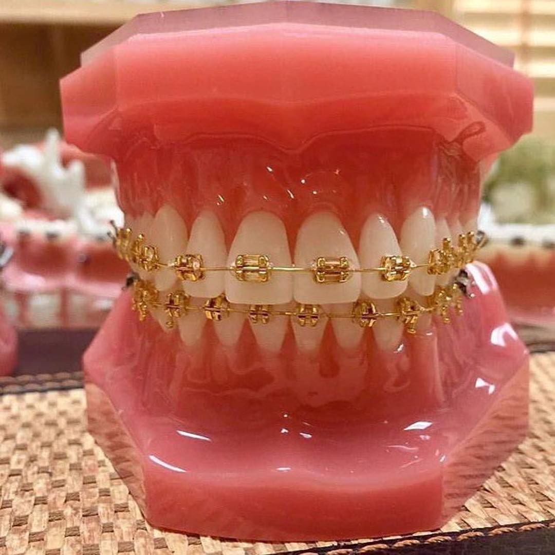 Gold Braces Teeth