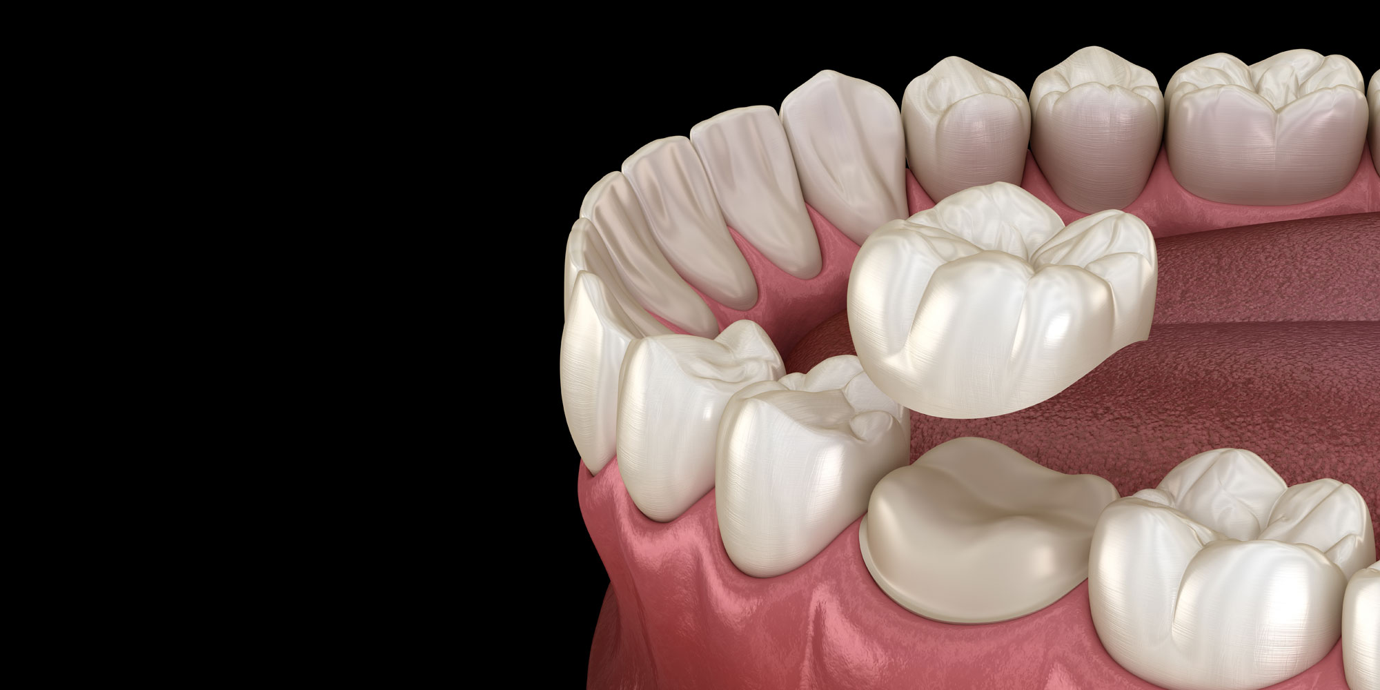 Gold Crowns Benefits: Smile Restoration