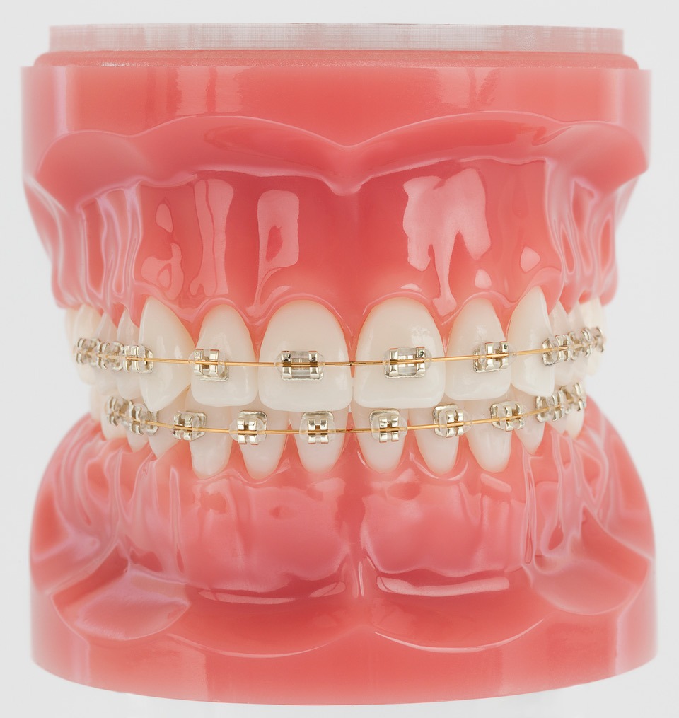 Gold Metal Braces