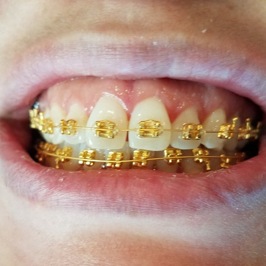 Gold Teeth Braces