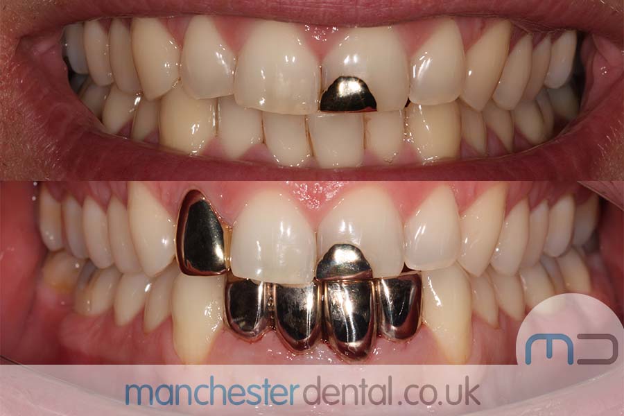 Gold Teeth Crowns