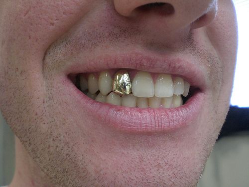 Gold Tooth Cap Costs Revealed