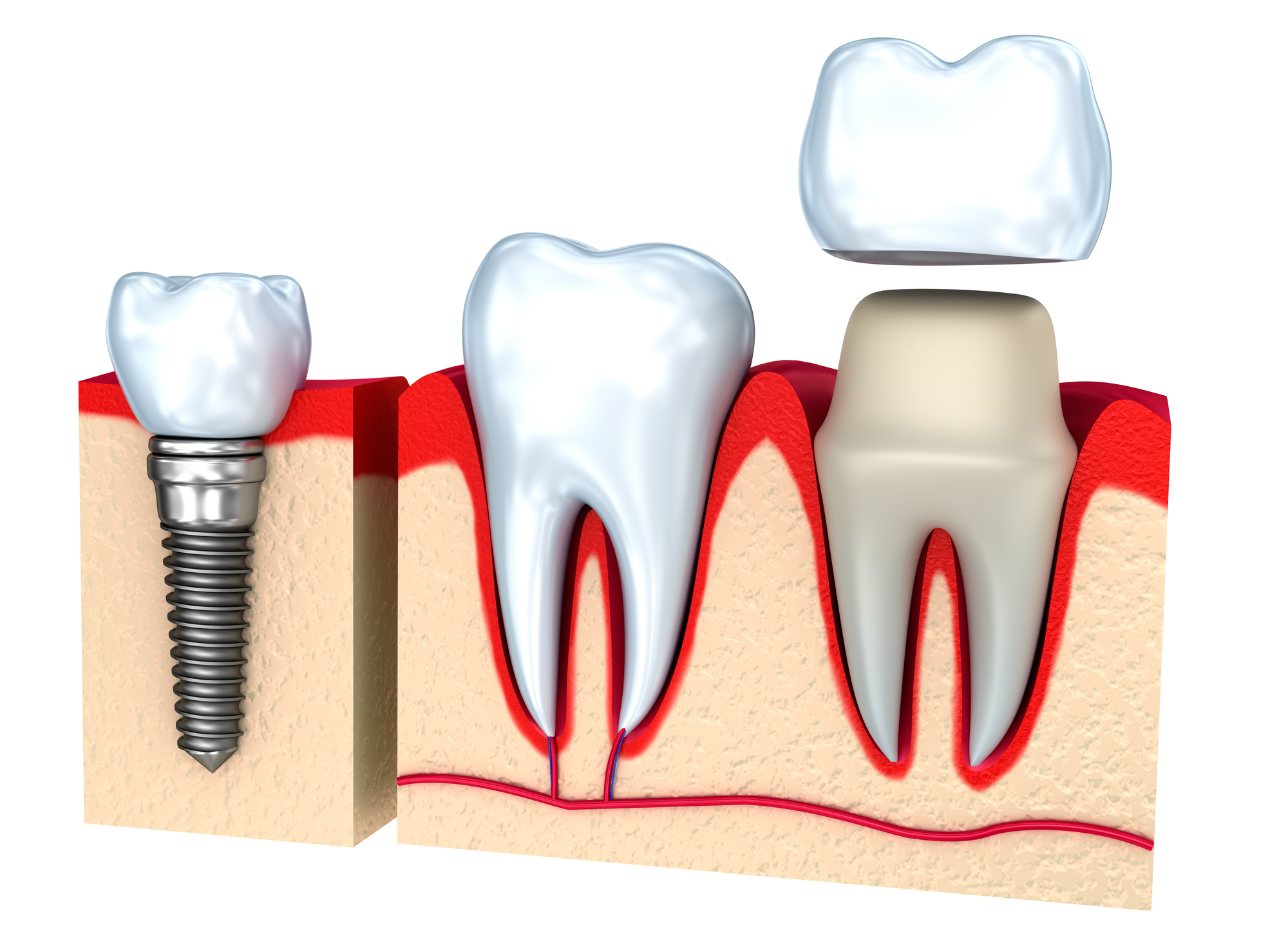 Gold Tooth Cap Procedure Explained