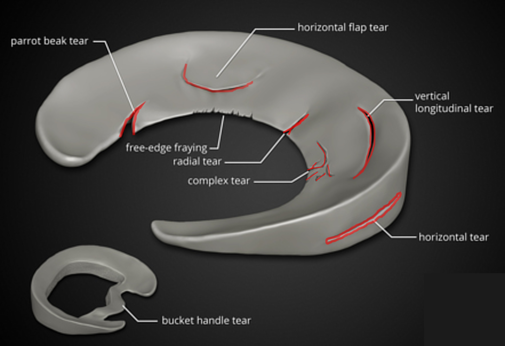 Grade 3 Meniscus Treatment: Full Recovery Tips