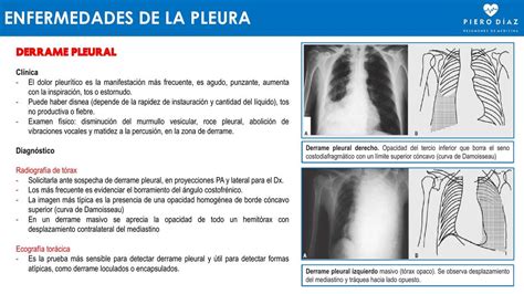 Grados De Derrame Pleural