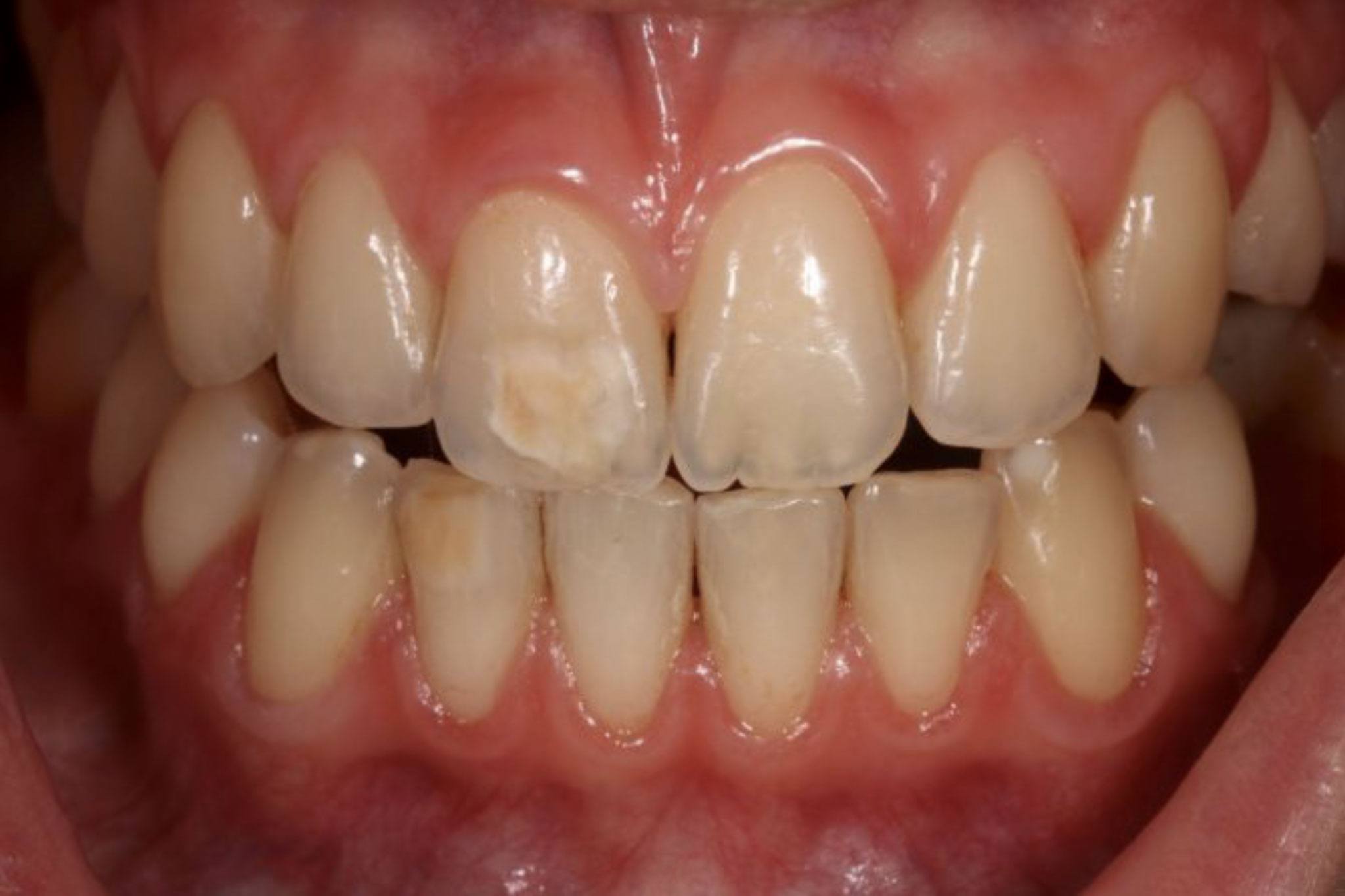 Green Spots On Teeth
