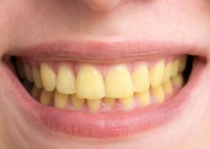 Green Tea And Teeth Stains