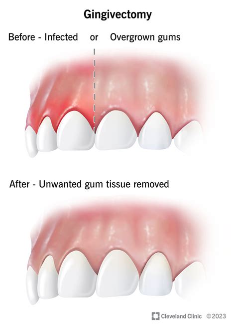 Gum Cuts Between Teeth: Prevention Guide