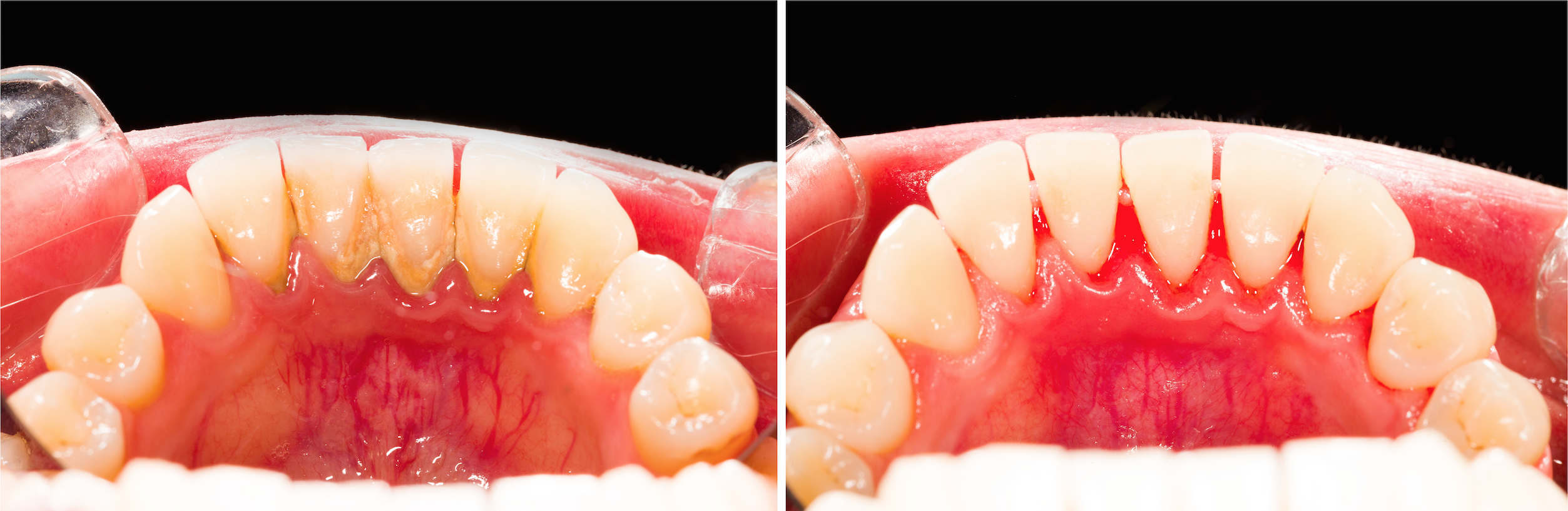 Gum For Cleaning Teeth
