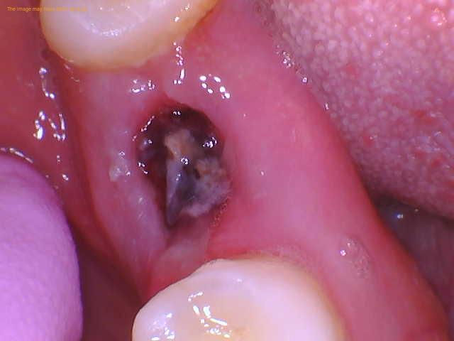 Gum Infection After Extraction: Heal Faster Naturally Gum Infection After Extraction: Heal Faster Naturally