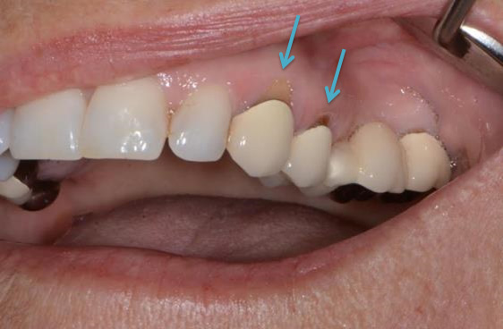 Gum Receding Around Crown Does Dentistry Cause Recession Gum Receding Around Crown Does Dentistry Cause Recession