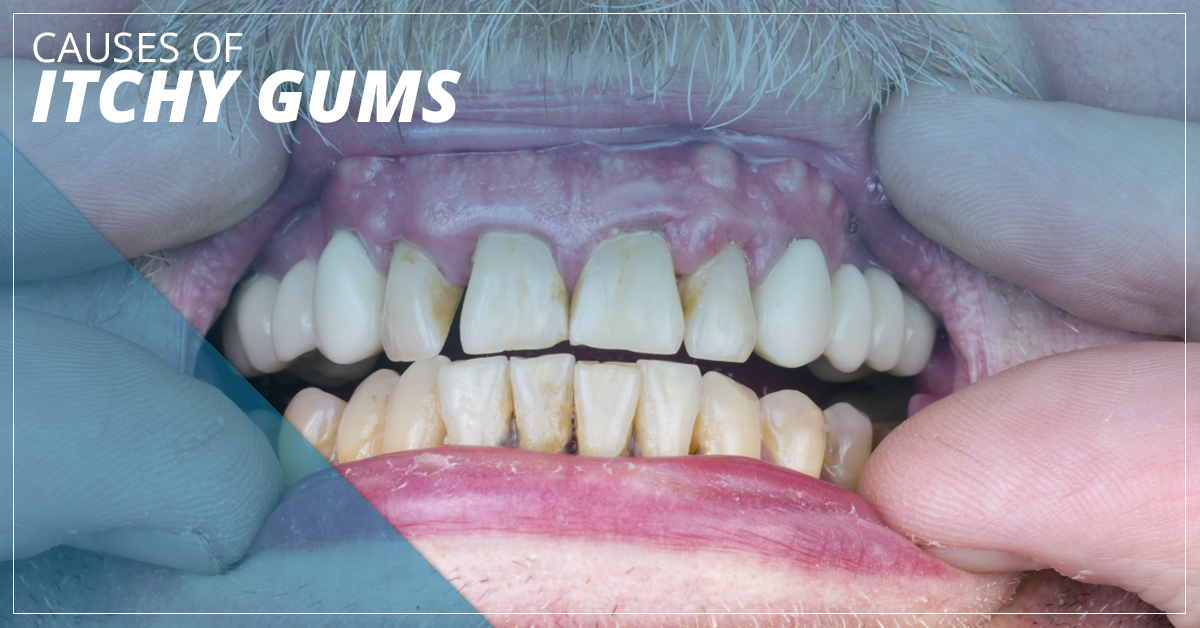 Gums Feeling Itchy