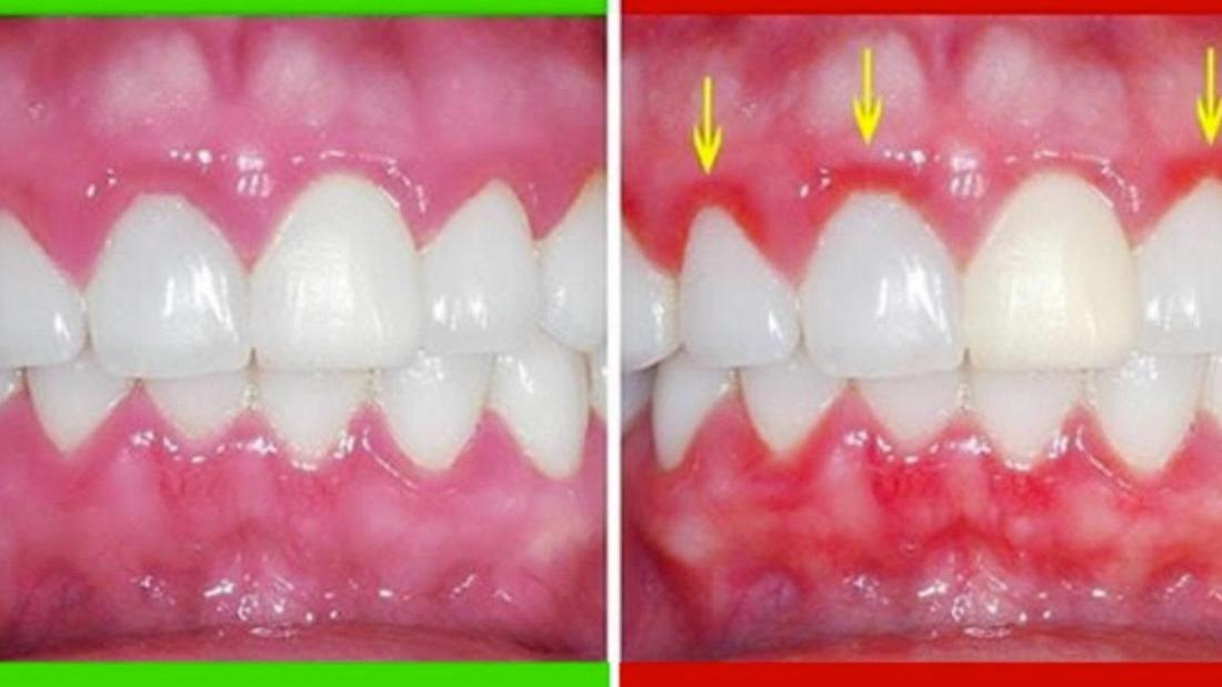 Gums Puffy After Flossing: Reduce Swelling Fast Gums Puffy After Flossing: Reduce Swelling Fast
