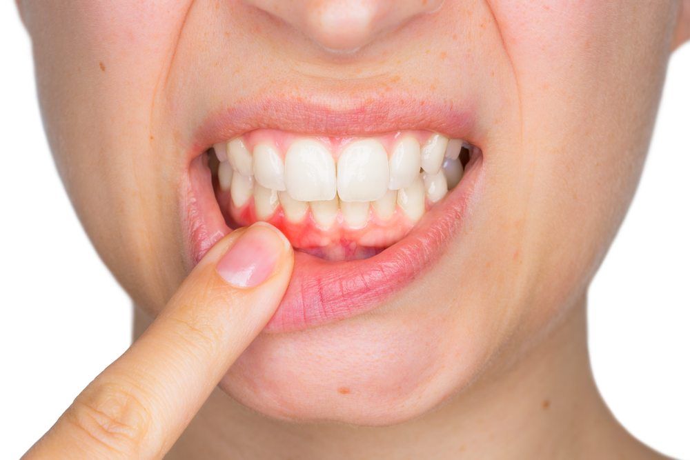 Gums Swollen Around One Tooth Gums Swollen Around One Tooth