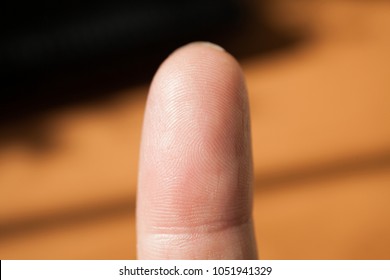 Hand Bruise And Swelling