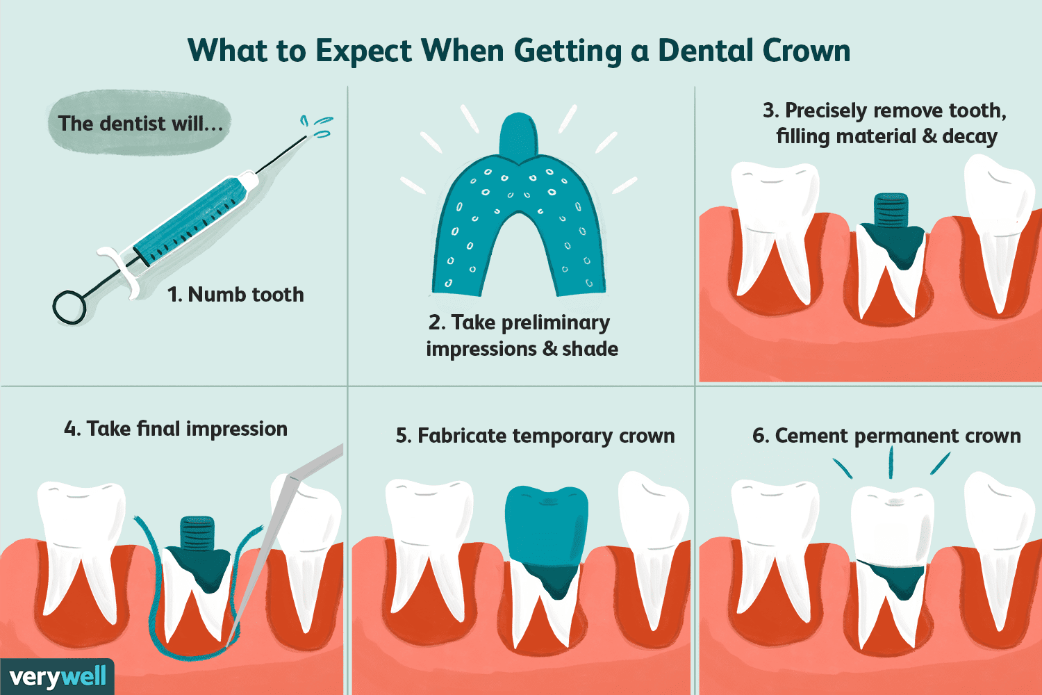 Having A Crown Fitted