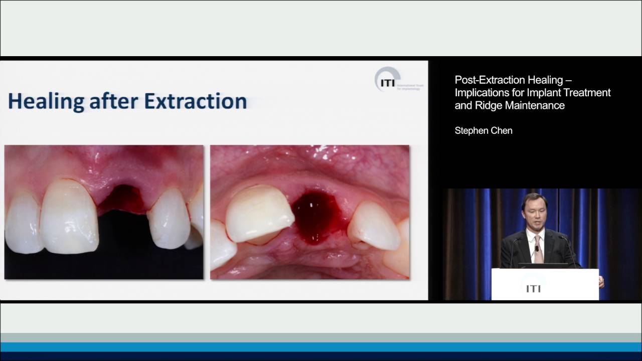 Healing Time For Molar Extraction
