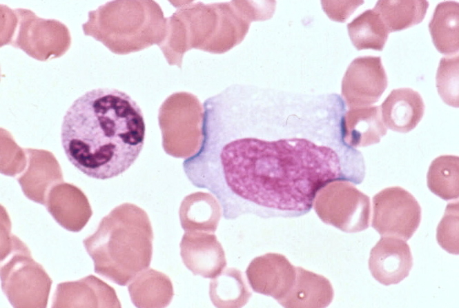 High Segs And Low Lymphs