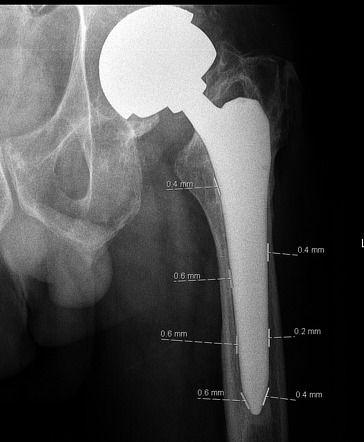 Hip Prosthesis Loosening Symptoms Hip Prosthesis Loosening Symptoms