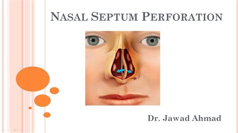 Hole In Nose Cartilage