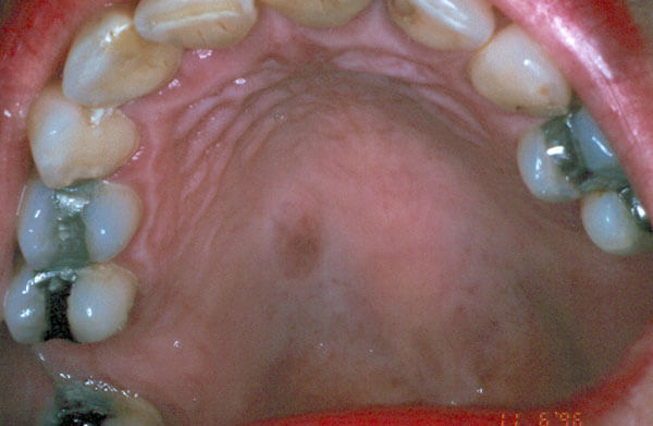 Holes In Roof Of Mouth
