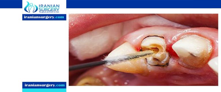 Horrible Pain After Root Canal