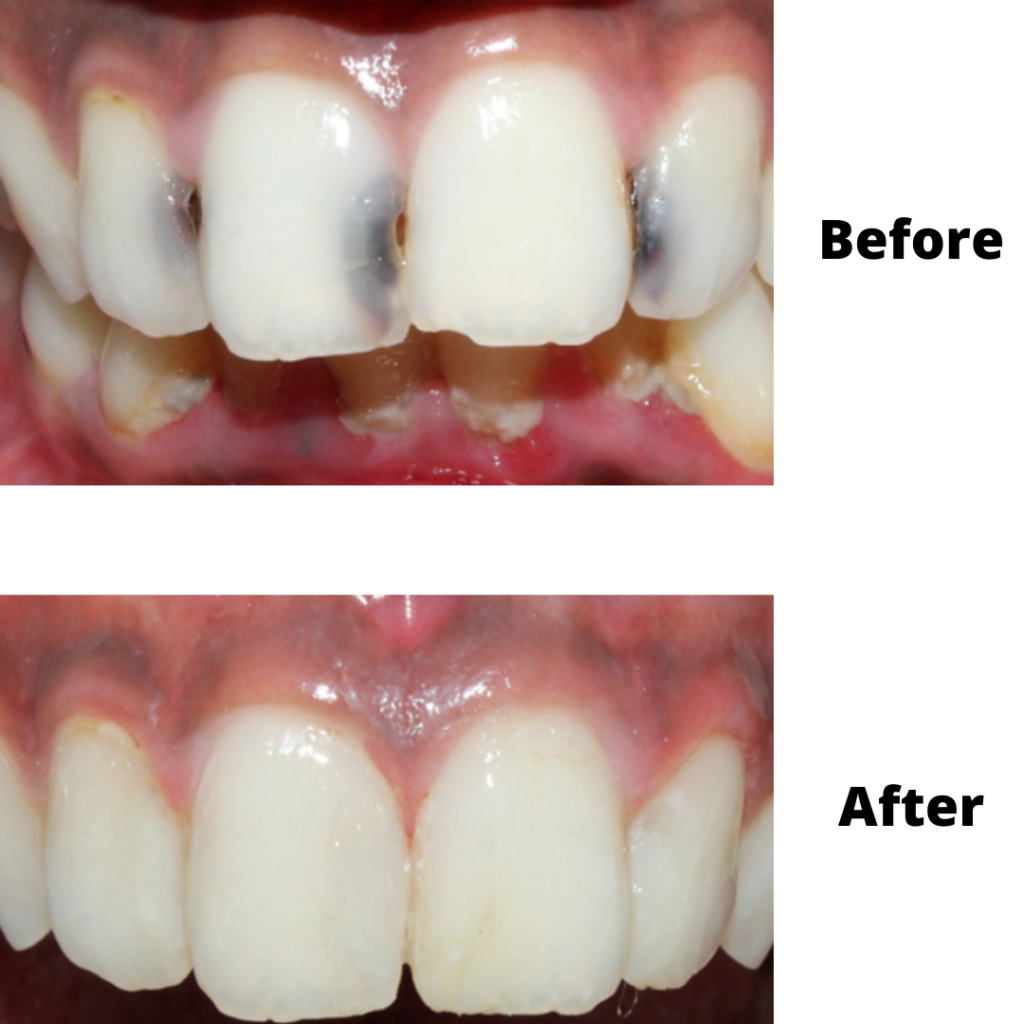 How Do Front Teeth Fillings Work? Easy Repair Guide