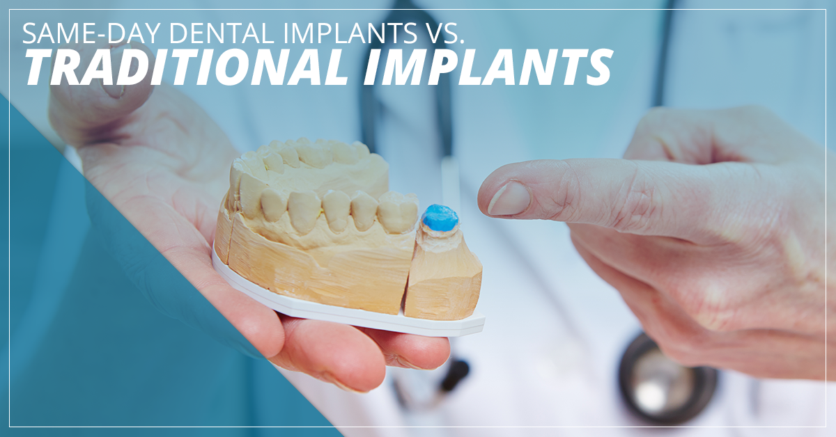 How Do Same Day Tooth Implants Work? Painfree Answers