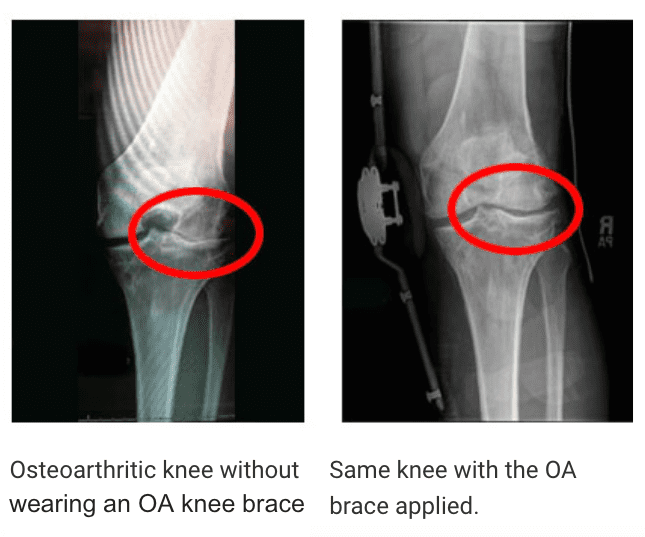How Do Unloading Knee Braces Work? Instant Pain Relief