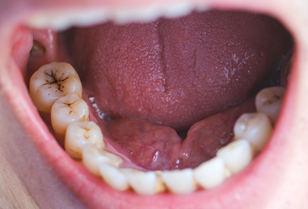 How Does Ozone Therapy Work? Effective Tooth Decay Treatment
