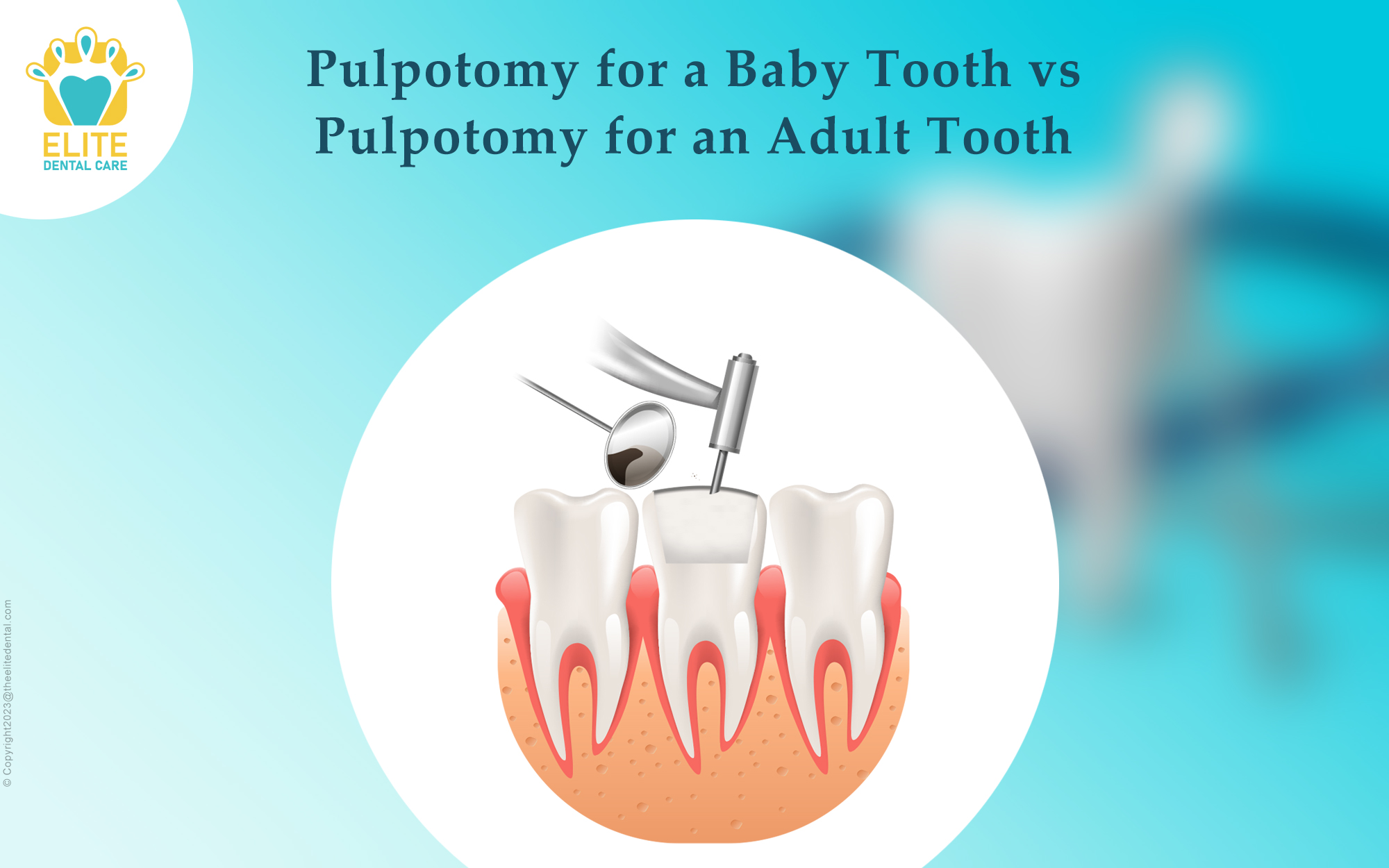 How Does Pulpotomy Work? Save Your Tooth Now