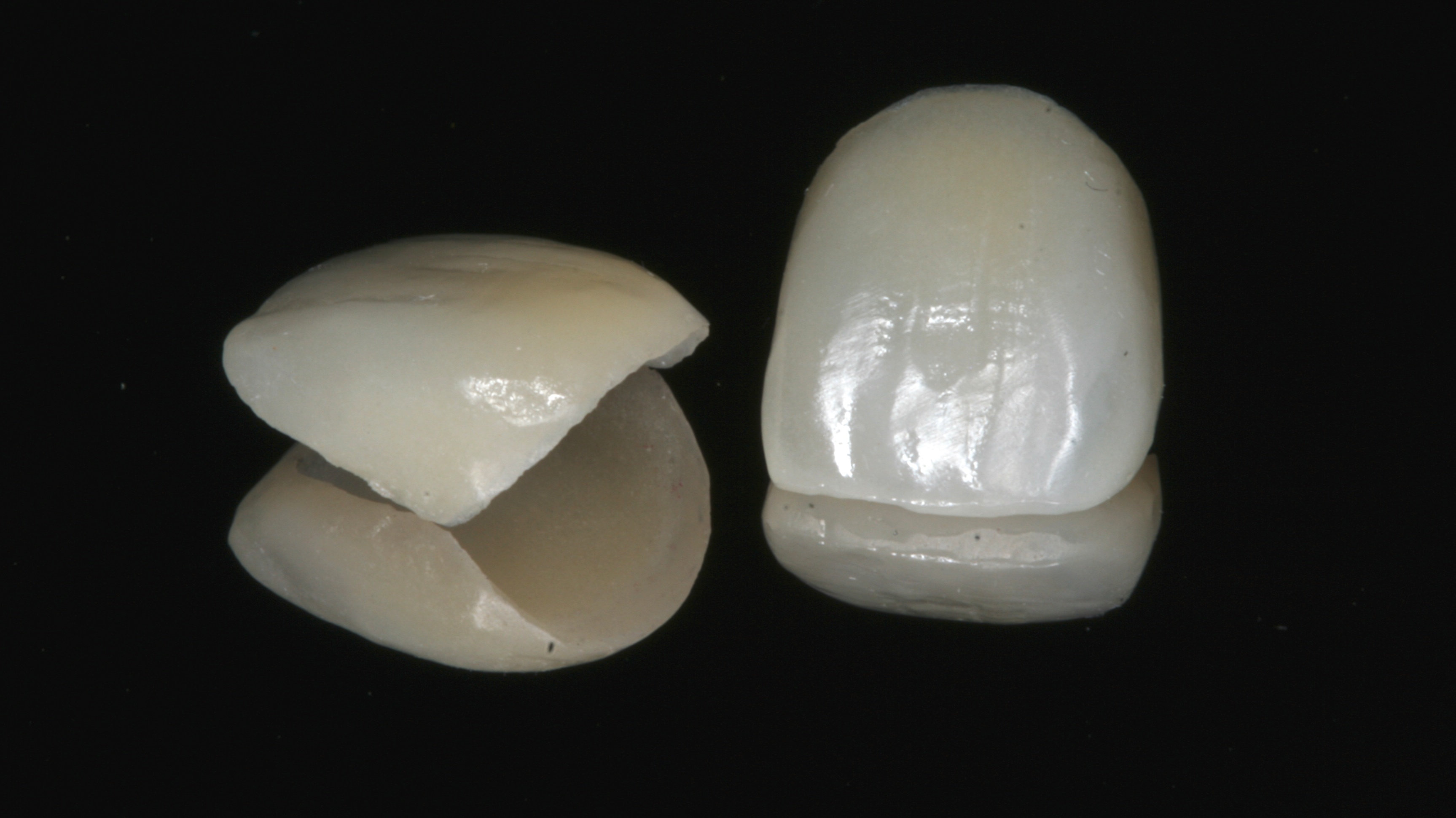 How Durable Are Porcelain Veneers? Lasting Results