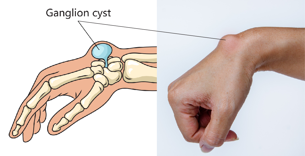 How Long Do Ganglion Cysts Last After Surgery? Treatment Options